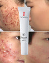 Effective whitening cream, can remove acne essence, treat bleaching, acne spots, control sebum,