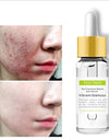 Effective whitening cream, can remove acne essence, treat bleaching, acne spots, control sebum,